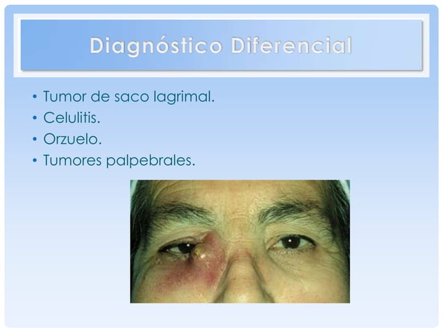 Dacriocistitis aguda