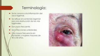 Terminología:
 Se le conoce a la inflamación del
saco lagrimal.
 Se refluye el contenido lagrimal
por una obstrucción de las vías
lagrimales.
 Son poco frecuente.
 Son infecciones unilaterales
 Con mayor frecuencia en
lactantes y mujeres mayores de
40 a 50 años.
 