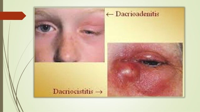 Dacroadenitis