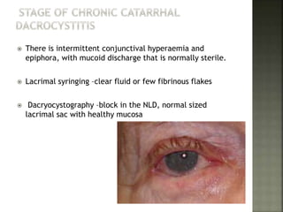  There is intermittent conjunctival hyperaemia and
epiphora, with mucoid discharge that is normally sterile.
 Lacrimal syringing –clear fluid or few fibrinous flakes
 Dacryocystography –block in the NLD, normal sized
lacrimal sac with healthy mucosa
 