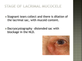  Stagnant tears collect and there is dilation of
the lacrimal sac, with mucoid content.
 Dacryocystography –distended sac with
blockage in the NLD.
 