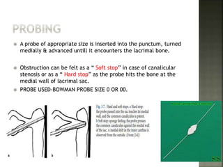  A probe of appropriate size is inserted into the punctum, turned
medially & advanced untill it encounters the lacrimal bone.
 Obstruction can be felt as a “ Soft stop” in case of canalicular
stenosis or as a “ Hard stop” as the probe hits the bone at the
medial wall of lacrimal sac.
 PROBE USED-BOWMAN PROBE SIZE 0 OR 00.
 