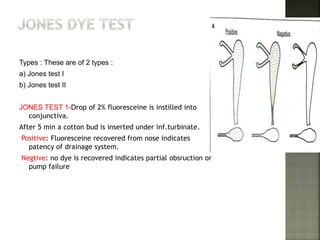 Types : These are of 2 types :
a) Jones test I
b) Jones test II
JONES TEST 1-Drop of 2% fluoresceine is instilled into
conjunctiva.
After 5 min a cotton bud is inserted under inf.turbinate.
Positive: Fluoresceine recovered from nose indicates
patency of drainage system.
Negtive: no dye is recovered indicates partial obsruction or
pump failure
 