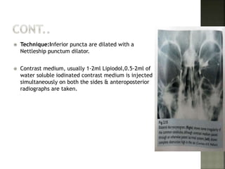  Technique:Inferior puncta are dilated with a
Nettleship punctum dilator.
 Contrast medium, usually 1-2ml Lipiodol,0.5-2ml of
water soluble iodinated contrast medium is injected
simultaneously on both the sides & anteroposterior
radiographs are taken.
 