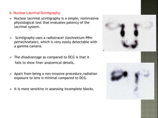 b. Nuclear Lacrimal Scintigraphy:
 Nuclear lacrimal scintigraphy is a simple, noninvasive
physiological test that evaluates patency of the
lacrimal system.
 Scintigraphy uses a radiotracer (technetium-99m
pertechnetate), which is very easily detectable with
a gamma camera.
 The disadvantage as compared to DCG is that it
fails to show finer anatomical details.
 Apart from being a non-invasive procedure,radiation
exposure to lens is minimal compared to DCG.
 It is more sensitive in assessing incomplete blocks.
 