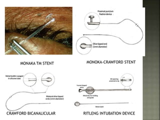 MONAKA TM STENT MONOKA-CRAWFORD STENT
CRAWFORD BICANALICULAR RITLENG INTUBATION DEVICE
 
