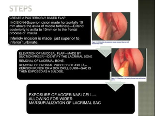 CREATE A POSTERIORLY BASED FLAP
IINCISIONSuperior icision made horizontally 10
mm above the axilla of middle turbinate—Extend
posteriorly to axilla to 10mm on to the frontal
process of maxila
Inferioly incision is made just superior to
inferior turbinate.
ELEVATION OF MUCOSAL FLAP—MADE BY
SUCTION FREER—IDENTIFY THE LACRIMAL BONE
REMOVAL OF LACRIMAL BONE.
REMOVAL OF FRONTAL PROCESS OF AXILLA –
KERISON PUNCH OR A DCR DRILL BURR—SAC IS
THEN EXPOSED AS A BULDGE.
EXPOSURE OF AGGER NASI CELL—
ALLOWING FOR WIDER
MARSUPIALIZATON OF LACRIMAL SAC
 