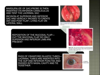 MARSUPALIZE OF SAC-PROBE IS THEN
INSERTED VIA INFERIOR CANALICULUS
AND TENT THE LACRIMAL SAC
INCISION AT SUPERIOR AND INFERIOR
SAC AND VERICALY INCISED TO CREATE
ANT AND POST FLAP—LYING FLAT ON
LATERAL WALL
REPOSITION OF THE MUCOSAL FLAP—
CUT THE MUCOSAL FLAP SO ONLY
SUPERIOR AND INFERIOR LIMB ARE
PRESENT
PASS OF CRAWFORD SILASTIC TUBES—
LACRIMAL TUBES ARE INSERTED INTO
THE SUP AND INFERIOR PUNCTAE AND
PASSED INTO NASAL CAVITY AND TIE
TOGETHER
 