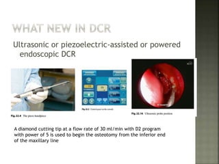 Ultrasonic or piezoelectric-assisted or powered
endoscopic DCR
A diamond cutting tip at a flow rate of 30 ml/min with D2 program
with power of 5 is used to begin the osteotomy from the inferior end
of the maxillary line
 