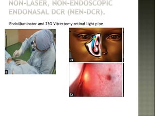 Endoilluminator and 23G Vitrectomy retinal light pipe
 