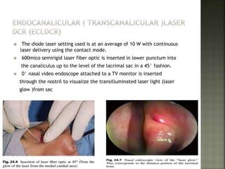  The diode laser setting used is at an average of 10 W with continuous
laser delivery using the contact mode.
 600mico semirigid laser fiber optic is inserted in lower punctum into
the canaliculus up to the level of the lacrimal sac in a 45° fashion.
 0° nasal video endoscope attached to a TV monitor is inserted
through the nostril to visualize the transilluminated laser light (laser
glow )from sac
 