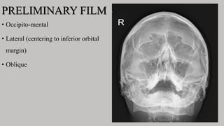 PRELIMINARY FILM
• Occipito-mental
• Lateral (centering to inferior orbital
margin)
• Oblique
 