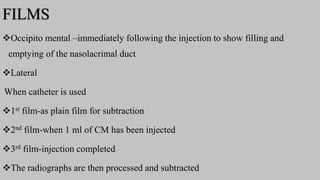 FILMS
Occipito mental –immediately following the injection to show filling and
emptying of the nasolacrimal duct
Lateral
When catheter is used
1st film-as plain film for subtraction
2nd film-when 1 ml of CM has been injected
3rd film-injection completed
The radiographs are then processed and subtracted
 