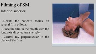 Filming of SM
Inferior superior
-Elevate the patient's thorax on
several firm pillows.
- Place the film in the mouth with the
long axis directed transversely.
- Central ray perpendicular to the
plane of the film
 