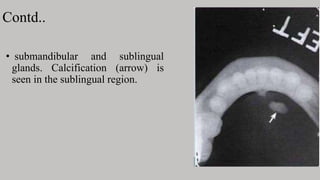 Contd..
• submandibular and sublingual
glands. Calcification (arrow) is
seen in the sublingual region.
 
