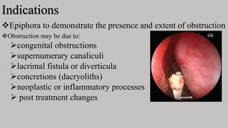 Indications
Epiphora to demonstrate the presence and extent of obstruction
Obstruction may be due to:
congenital obstructions
supernumerary canaliculi
lacrimal fistula or diverticula
concretions (dacryoliths)
neoplastic or inflammatory processes
 post treatment changes
 