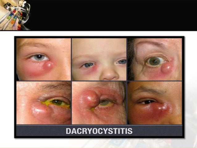 dacryocystitis 4 638