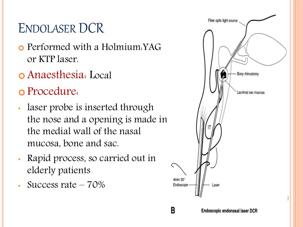 Dacryocystorhinostomy