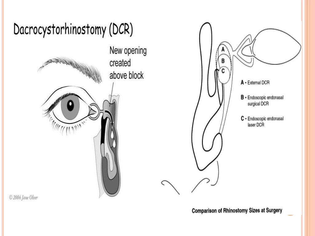 Dacrocystorhinostomy Pictures