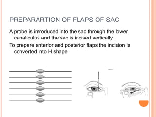 PREPARARTION OF FLAPS OF SAC
A probe is introduced into the sac through the lower
canaliculus and the sac is incised vertically .
To prepare anterior and posterior flaps the incision is
converted into H shape
 
