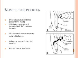 SILIASTIC TUBE INSERTION
 Done in canalicular block
(upper level block)
 Silicon tubes are passed
through both the puncta to
the nose
 All the anterior structures are
sutured in layers.
 Tubes are removed after 2-3
months.
 Success rate of over 90%
 