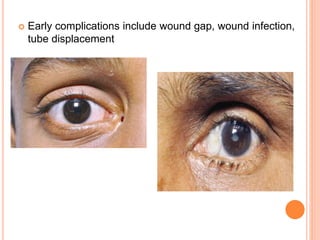  Early complications include wound gap, wound infection,
tube displacement
 