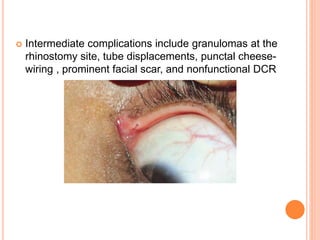  Intermediate complications include granulomas at the
rhinostomy site, tube displacements, punctal cheese-
wiring , prominent facial scar, and nonfunctional DCR
 
