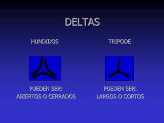 DELTAS
HUNDIDOS TRIPODE
PUEDEN SER:
ABIERTOS O CERRADOS
PUEDEN SER:
LARGOS O CORTOS
 