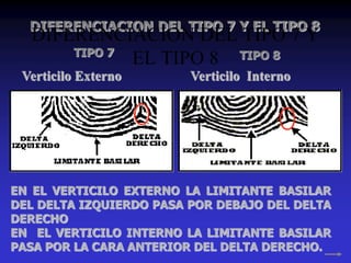DIFERENCIACION DEL TIPO 7 Y EL TIPO 8
Verticilo Externo Verticilo Interno
EN EL VERTICILO EXTERNO LA LIMITANTE BASILAR
DEL DELTA IZQUIERDO PASA POR DEBAJO DEL DELTA
DERECHO
EN EL VERTICILO INTERNO LA LIMITANTE BASILAR
PASA POR LA CARA ANTERIOR DEL DELTA DERECHO.
TIPO 7 TIPO 8
DIFERENCIACION DEL TIPO 7 Y
EL TIPO 8
 