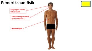Pemeriksaan fisik
    Konjungtiva anemis
    Sklera ikterik

     Frenulum lingua ikterik
     Oral candidiasis (-)




     Hepatomegali
 