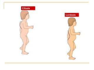 Cifosis

          Lordosis
 