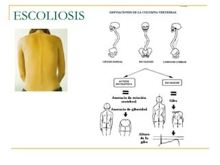 ESCOLIOSIS
 
