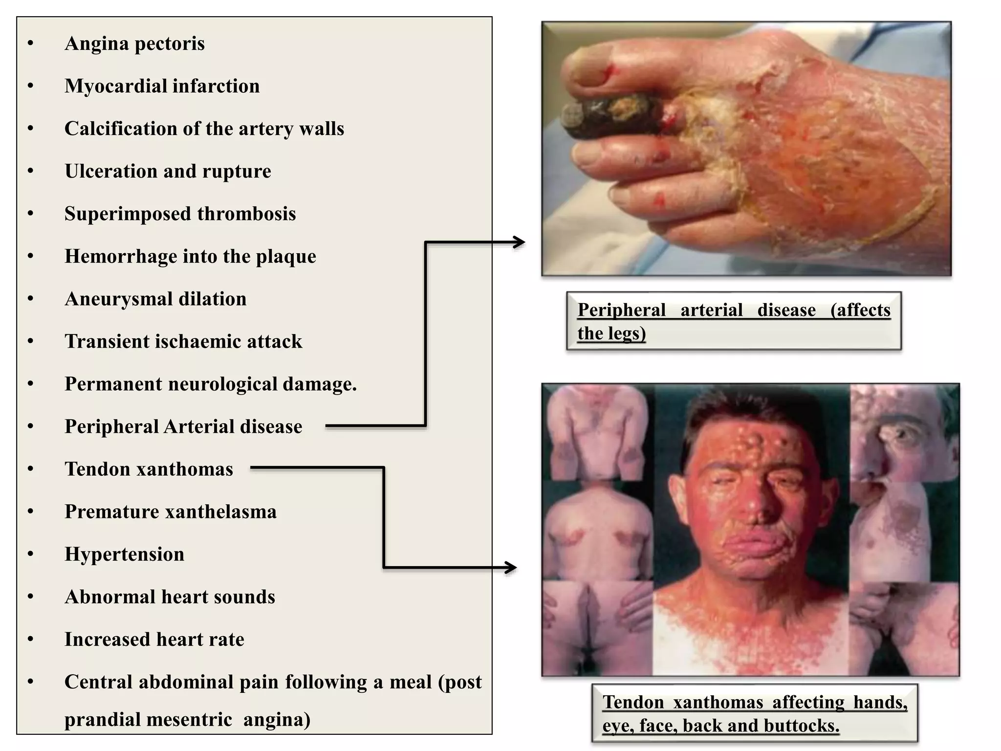 • Angina pectoris
• Myocardial infarction
• Calcification of the artery walls
• Ulceration and rupture
• Superimposed thrombosis
• Hemorrhage into the plaque
• Aneurysmal dilation
• Transient ischaemic attack
• Permanent neurological damage.
• Peripheral Arterial disease
• Tendon xanthomas
• Premature xanthelasma
• Hypertension
• Abnormal heart sounds
• Increased heart rate
• Central abdominal pain following a meal (post
prandial mesentric angina)
Peripheral arterial disease (affects
the legs)
Tendon xanthomas affecting hands,
eye, face, back and buttocks.
 