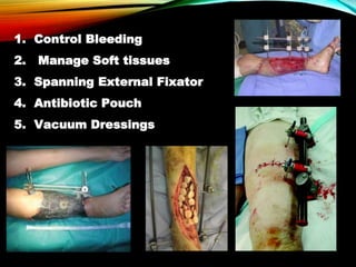 1. Control Bleeding
2. Manage Soft tissues
3. Spanning External Fixator
4. Antibiotic Pouch
5. Vacuum Dressings
 