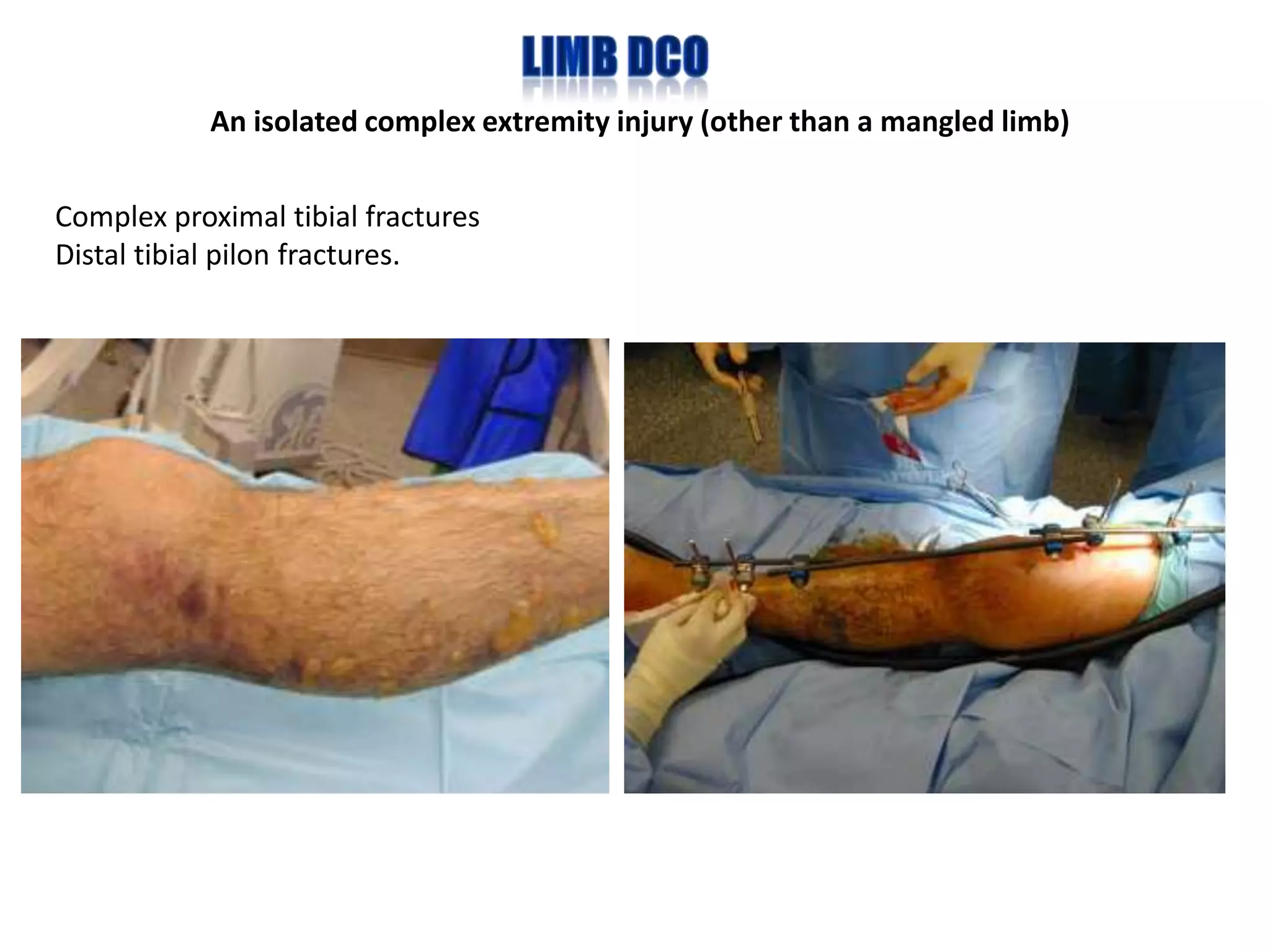 An isolated complex extremity injury (other than a mangled limb)


Complex proximal tibial fractures
Distal tibial pilon fractures.
 
