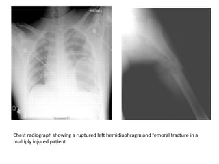 Chest radiograph showing a ruptured left hemidiaphragm and femoral fracture in a
multiply injured patient
 