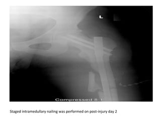 Staged intramedullary nailing was performed on post-injury day 2
 