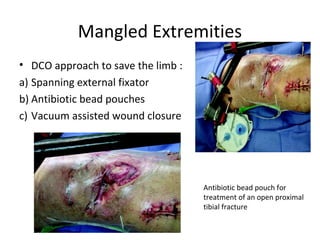 Mangled Extremities
• DCO approach to save the limb :
a) Spanning external fixator
b) Antibiotic bead pouches
c) Vacuum assisted wound closure
Antibiotic bead pouch for
treatment of an open proximal
tibial fracture
 