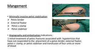 Mangement
• Minimally invasive pelvic stabilisation
➢ Pelvic binder
➢ External fixator
➢ Pelvic c-clamp
➢ Pelvic stabilizer
• Angiography and embolisation Indications :
1.Initial treatment of pelvic fractures associated with hypotension that
have not responded to the placement of a pelvic binder, external fixator,
pelvic c- clamp, or pelvic stabilizer and transfusion of four units or more
of blood
 