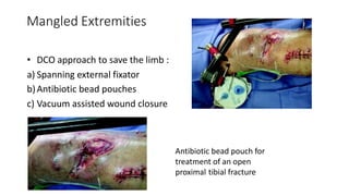 Mangled Extremities
• DCO approach to save the limb :
a) Spanning external fixator
b)Antibiotic bead pouches
c) Vacuum assisted wound closure
Antibiotic bead pouch for
treatment of an open
proximal tibial fracture
 