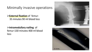 Minimally invasive operations
➢External fixation of femur-
35 minutes 90 ml blood loss
➢Intramedullary nailing of
femur-130 minutes 400 ml blood
loss
 