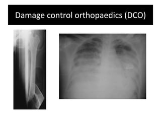 Damage control orthopaedic surgery | PPTX