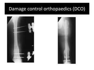 Damage control orthopaedic surgery | PPTX