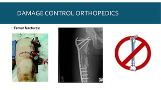 DAMAGE CONTROL ORTHOPEDICS
 Femur fractures:
 