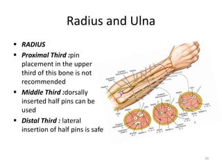 Damage Control Orthopedics and Principles of External Fixation.pptx