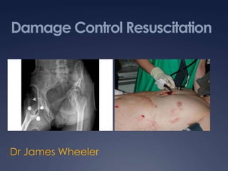 Damage Control Resuscitation
Dr James Wheeler
 