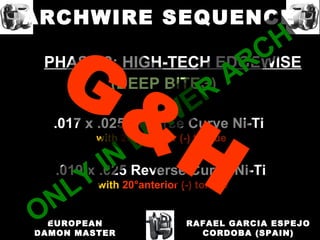 PHASE 2: HIGH-TECH EDGEWISE
(DEEP BITES)
.017 x .025 Reverse Curve Ni-Ti
with 20°anterior (-) torque
.019 x .025 Reverse Curve Ni-Ti
with 20°anterior (-) torque
RAFAEL GARCIA ESPEJO
CORDOBA (SPAIN)
EUROPEAN
DAMON MASTER
ARCHWIRE SEQUENCE
ONLY
IN
LOW
ER
ARCH
ONLY
IN
LOW
ER
ARCH
G&
H
 