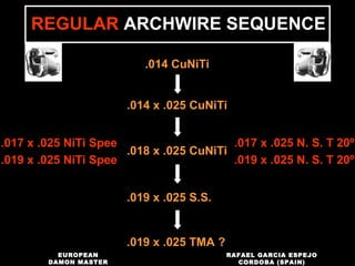 .014 CuNiTi
.014 x .025 CuNiTi
.018 x .025 CuNiTi
.019 x .025 S.S.
.019 x .025 TMA ?
REGULAR ARCHWIRE SEQUENCE
.017 x .025 NiTi Spee
.019 x .025 NiTi Spee
.017 x .025 N. S. T 20º
.019 x .025 N. S. T 20º
RAFAEL GARCIA ESPEJO
CORDOBA (SPAIN)
EUROPEAN
DAMON MASTER
 