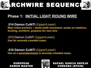 Phase 1: INITIAL LIGHT ROUND WIRE
.014 Damon CuNiTi (Upper/Lower)
Main initial archwire – starts tooth movement, works on rotations,
leveling, archform, prepares for next wire
.013 Damon CuNiTi (Upper/Lower)
Use for severely crowded cases
.016 Damon CuNiTi (Upper/Lower)
Use as a secondarchwire in severely crowded cases.
RAFAEL GARCIA ESPEJO
CORDOBA (SPAIN)
EUROPEAN
DAMON MASTER
ARCHWIRE SEQUENCE
 