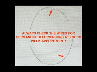 ALWAYS CHECK THE WIRES FOR
PERMANENT DEFORMATIONS AT THE 10
WEEK APPOINTMENT!
 